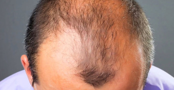 A drug promises to cure baldness