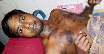 ভুল চিকিৎসায় জীবন-মৃত্যুর সন্ধিক্ষণে সুরুজ মিয়া