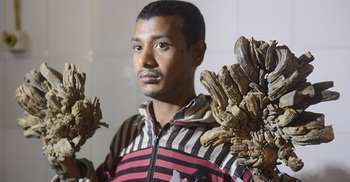 ‘Tree man’ Abul’s surgery done