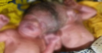 জোড়া লাগানো মাথা নিয়ে শিশুর জন্ম