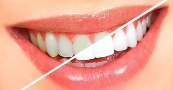 Whiten your teeth in just 3 minutes