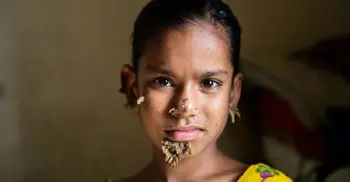 Sahana may be first female with ‘tree man syndrome’