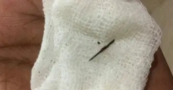 Needle removed from Man’s body after 22 years