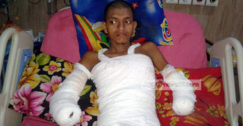 পল্লী বিদ্যুতের অবহেলায় হাত কাটা পড়ল মেধাবী ছাত্রের