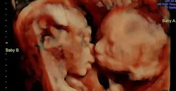 Couple witness their identical twins kissing in ultrasound