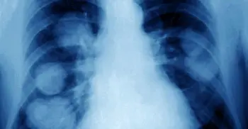 Cancer spread cut by 75% in tests