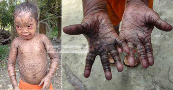 পল্লবের রোগ আরোগ্যযোগ্য নয়