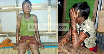 শাহাদাতের চিকিৎসা করাতে গিয়ে পরিবার নিঃস্ব