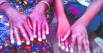 অসুস্থ গরুর মাংস খেয়ে ৯ জন অ্যানথ্রাক্স আক্রান্ত