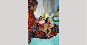 Conjoined twins to undergo surgery tomorrow
