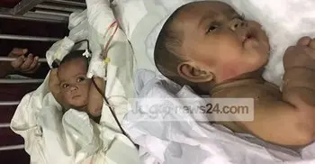 Conjoined twins separated at DMCH