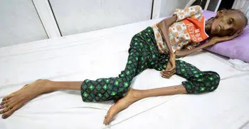 Yemen conflict: UN official warns of world’s biggest famine