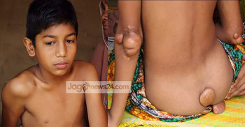 বিরল রোগে আক্রান্ত স্কুলছাত্র শাহান