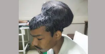India doctors remove world’s ‘largest brain tumour’