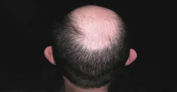 Why is hair loss more common in men than women?