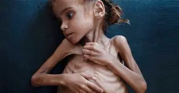 Yemen girl who turned world’s eyes to famine is dead