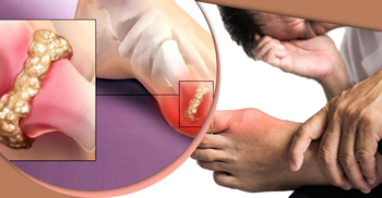 ইউরিক অ্যাসিড নিয়ন্ত্রণের সহজ উপায়