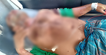 চাচার মুখ অ্যাসিডে ঝলসে দিলেন ভাতিজা