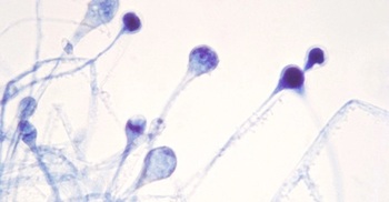 India reports nearly 9,000 'black fungus' cases