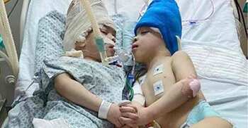 Conjoined twins separated with the help of virtual reality