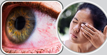 হঠাৎ চোখে ব্যথা ও জ্বালাপোড়া হতে পারে যে কারণে