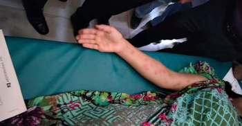 নির্যাতনবিরোধী কর্মসূচিতে মা-বোন, ঘরে অ্যাসিডে ঝলসে গেলো গৃহবধূ