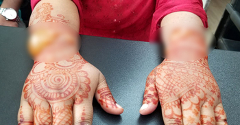 মেহেদি লাগিয়ে হাতে ফোসকা, কোম্পানিকে লাখ টাকা জরিমানা