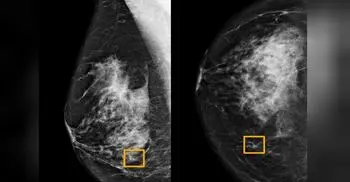 Google system could improve breast cancer detection