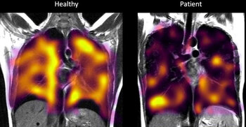 Long Covid: Hidden lung damage spotted on scans