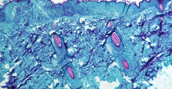 WHO expects more cases of monkeypox to emerge globally