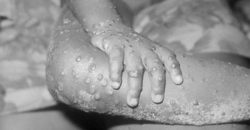 Monkeypox investigated in Europe, US, Australia