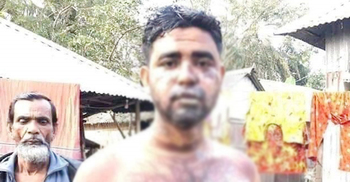 ঘুমের ওষুধ খাইয়ে স্বামীর গায়ে গরম পানি ঢেলে দেন স্ত্রী