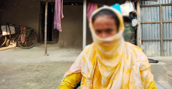 স্বামীর ছোড়া এসিডে ঝলসে গেছে নাক, মুখে নিতে হয় নিঃশ্বাস