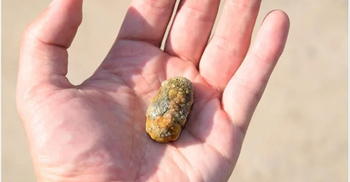 Gallstones: Causes, symptoms, diagnosis, treatment