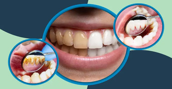 দাঁত হলদে হয়ে যাওয়ার কারণ কী?