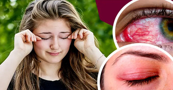 চোখে লালভাব, চুলকানি বা জ্বালাপোড়া! স্বাভাবিক নাকি বিপদের সংকেত?