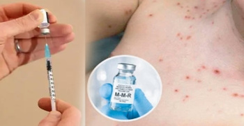 হামের টিকা সংকট ও অপুষ্টিতে বাড়ছে মৃত্যুঝুঁকি