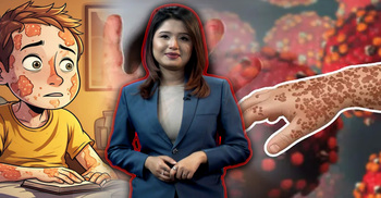 শিশুদের মধ্যে বাড়ছে হাম, জানুন ঝুঁকি ও সুরক্ষার উপায়