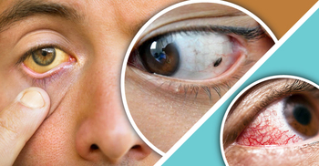 যেসব কঠিন রোগের লক্ষণ ফুটে ওঠে চোখে