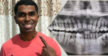 ৪২ দাঁত নিয়ে বিশ্বরেকর্ড