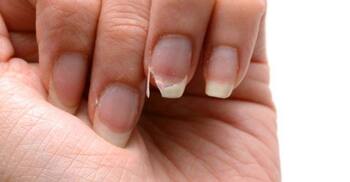 নখ ভেঙে যাচ্ছে? কোন পুষ্টি দরকার, কীসে পাবেন