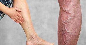 দীর্ঘক্ষণ দাঁড়িয়ে থাকলে হতে পারে ভ্যারিকোস ভেইনস