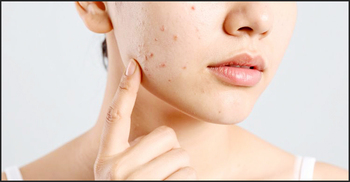 টিনএজ শেষ হয়েছে সেই কবে, তবু মুখে ব্রণ! কারণ জানুন