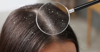 শীতকালে চুলে খুশকি বাড়ার আগেই নিন প্রতিরোধের ব্যবস্থা