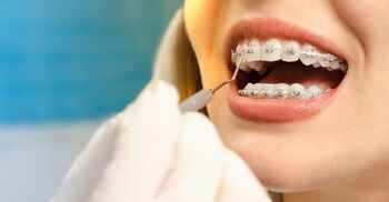 দাঁতে ব্রেসেস ব্যবহারের বিধান কী?