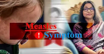 শিশুদের হামের লক্ষন যেভাবে বুঝবেন