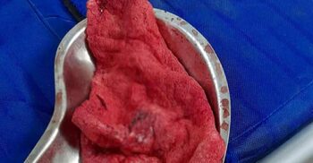 এক ফুট গজ রেখেই সেলাই, ৭ মাস পর অপারেশনে অপসারণ