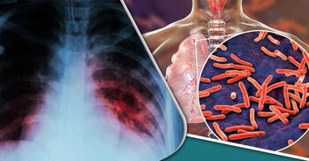 সিলেটে যক্ষ্মা আক্রান্তদের মধ্যে ৯ শতাংশই শিশু