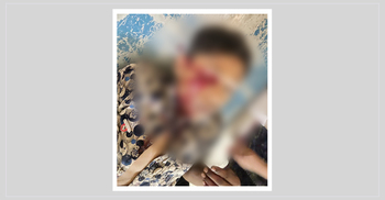 ফরিদপুরে বিস্ফোরণে তরুণ মারাত্মক জখম, উড়ে গেছে হাতের আঙুল