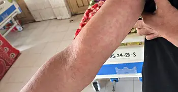 হামে আক্রান্ত হচ্ছেন বড়রাও, দুই শিশুর মৃত্যু